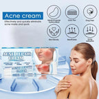 Sumifun Acne Treatment Cream - Clear & Smooth Skin Solution