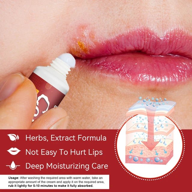 Sumifun Cheilitis Treatment Cream - Effective Relief for Lip Inflammation