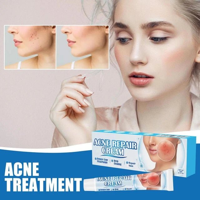 Sumifun Acne Treatment Cream - Clear & Smooth Skin Solution