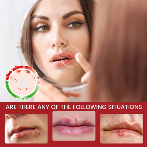 Sumifun Cheilitis Treatment Cream - Effective Relief for Lip Inflammation